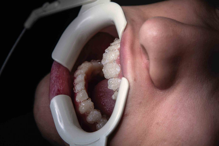 Snow Teeth Whitening: Why is so popular?